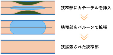 Pta シャント